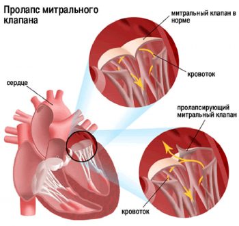 Пролапс митрального клапана: причины, виды, симптомы, диагностика и лечение
