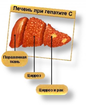 Вирусный гепатит у детей: симптомы, лечение