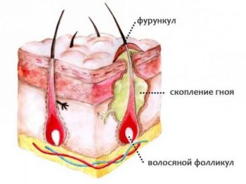 Фурункулез у детей: причины и лечение