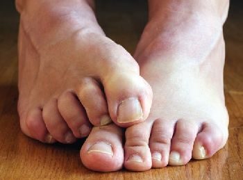 дерматомикоз: симптомы и лечение