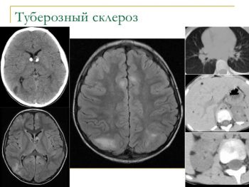 туберозный склероз симптомы и лечение
