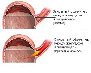 чем опасны изжога и ее самолечение