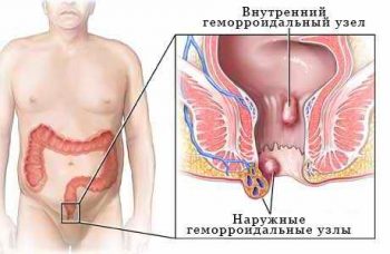Хирургическое лечение геморроя