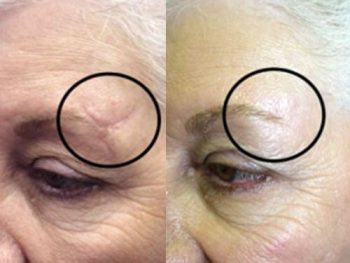 Мази от шрамов и рубцов: обзор препаратов