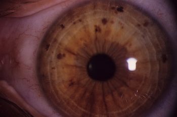 Нейрофиброматоз Реклингхаузена