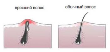 Вросшие волосы: как от них избавиться?