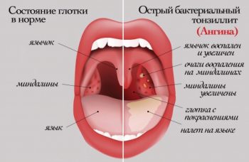 Какая бывает ангина: виды и симптомы