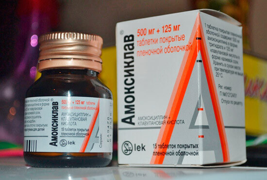 ангина при беременности