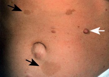 темные пятна на коже