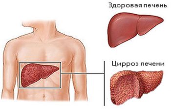 Первые симптомы проблем с печенью, которые не стоит игнорировать