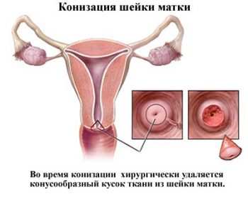 Дисплазия шейки матки: причины, симптомы, диагностика и лечение