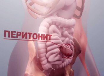 Что такое «острый живот»: симптомы, причины