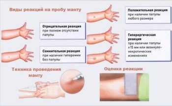 Прививка против туберкулеза детям и проба Манту