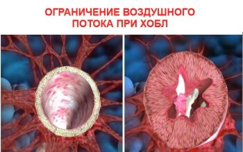 Хроническая обструктивная болезнь легких (ХОБЛ)
