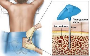 Миеломная болезнь: причины, симптомы и диагностика заболевания