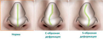 Утренний насморк: причины и способы избавления