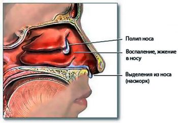 Утренний насморк: причины и способы избавления