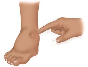 Нефротический синдром у детей: причины, симптомы, лечение и профилактика