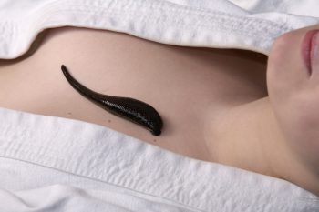 пиявка у девушки на груди