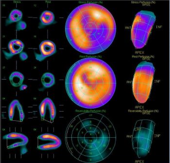 результат сцинтиграфии
