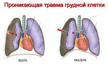 проникающая травма грудной клетки схема