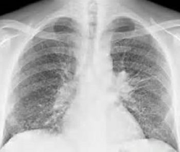 метастазы в легких при рентгене