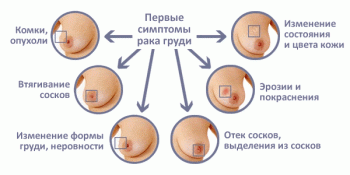 симптомы рака груди