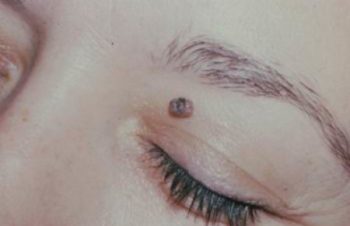 малигнизация озлокачествления родинки