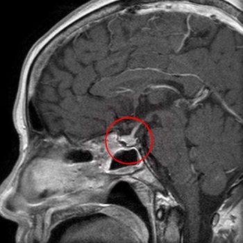 Пролактинома на МРТ