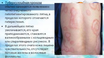 туберкулоидная проказа