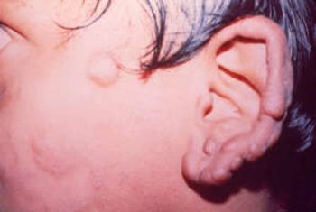 лепра проказа