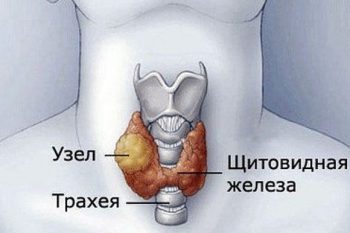 узел в щитовидной железе