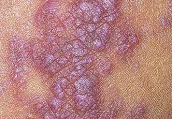 Сетка Уитхема