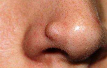 дерматофиброма твердая