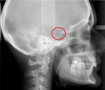 Рентген турецкого седла показания противопоказания методика проведения