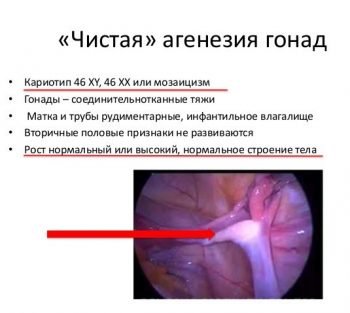 агенезия гонад