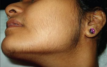 Аменорея причины симптомы лечение