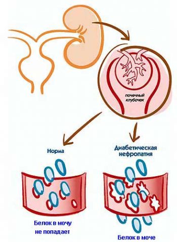 Белок в моче при сахарном диабете что это значит почему появляется