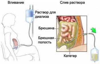 гравитационная хирургия крови