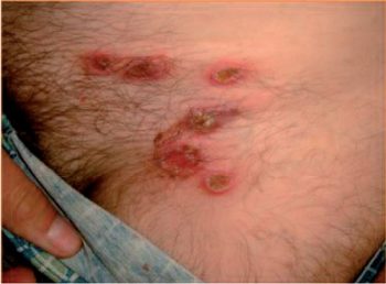 высыпания при вульгарной эктиме