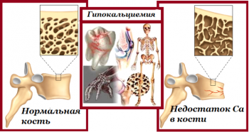Гипокальциемия симптомы лечение