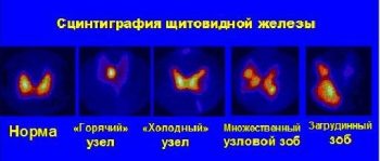 сцинтиграфия