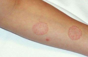 Красный плоский лишай кольцевидная форма