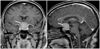 МРТ гипофиза при несахарном диабете
