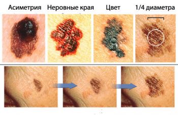 признаки малигнизации невуса