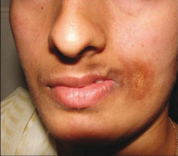 Гемиатрофия лица