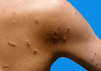 пруриго у взрослого