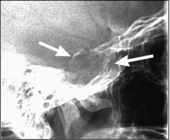 прицельная рентгенограмма турецкого седла