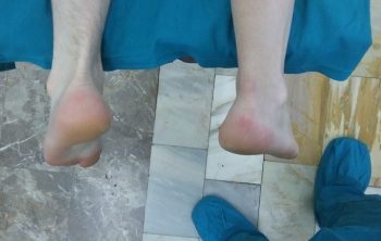 Разрыв ахиллова сухожилия операция