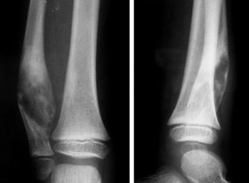 Ложный сустав после перелома причины лечение